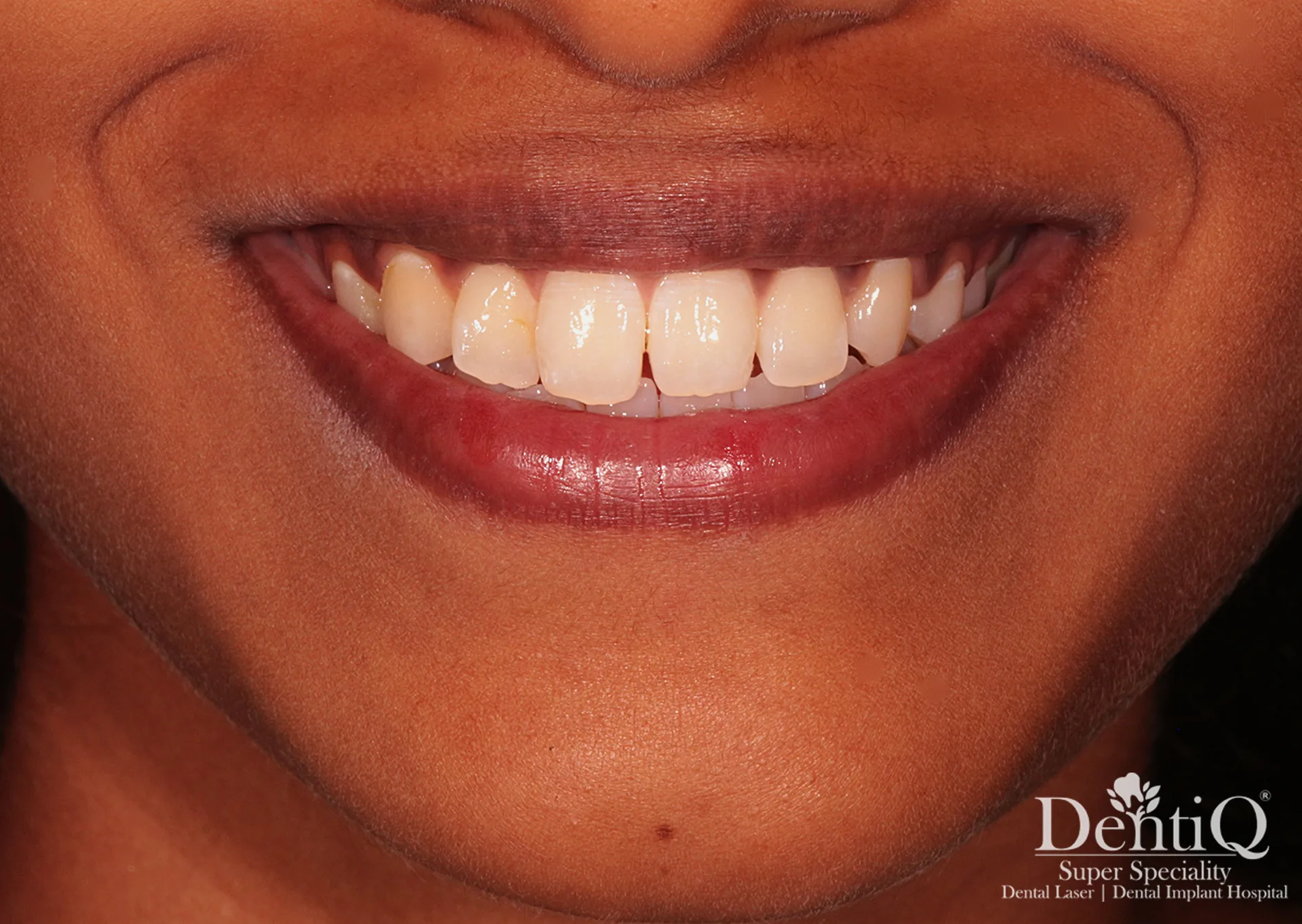 Full Smile Makeover - Before